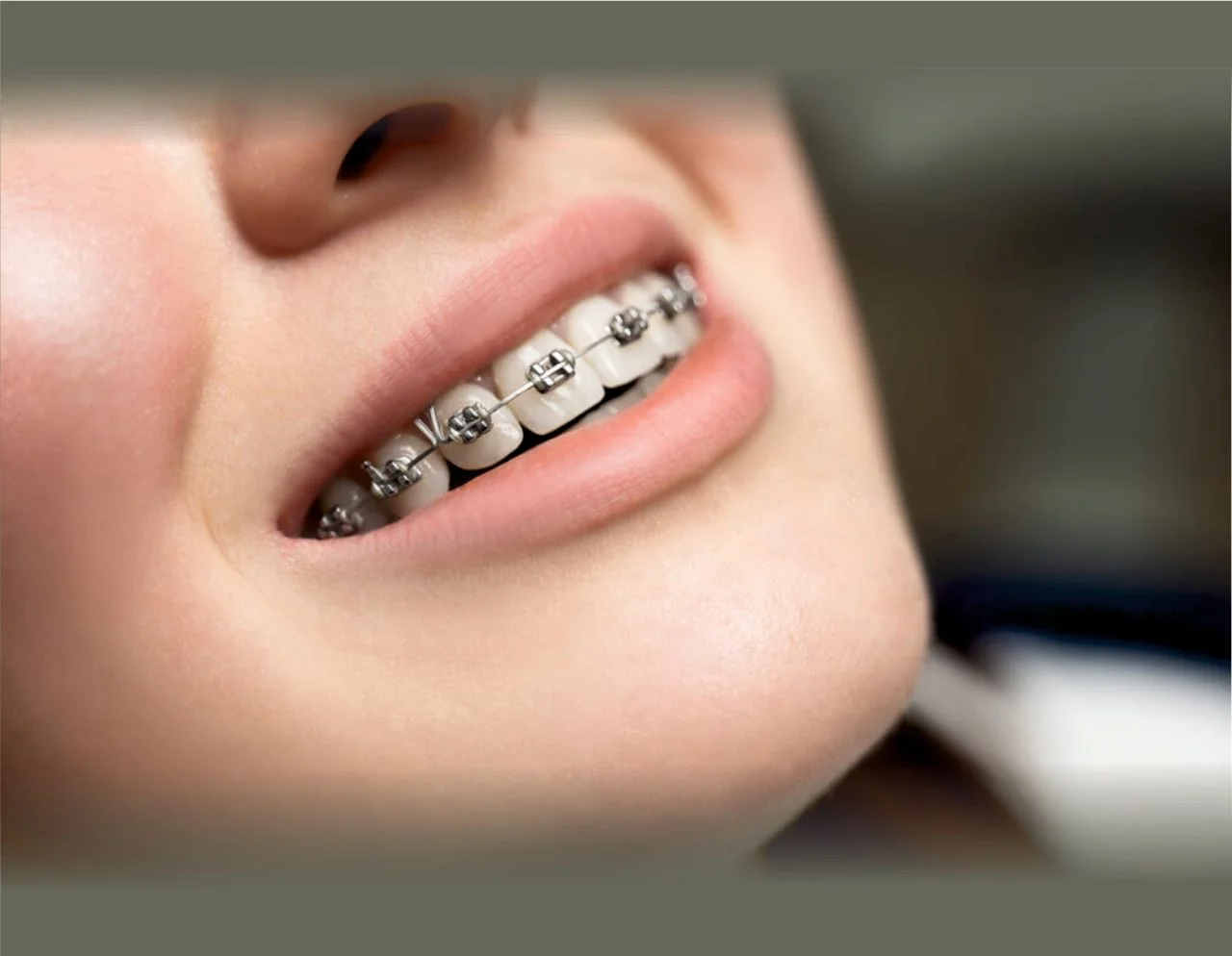 Orthodontics Braces